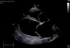 Echocardiogram_Newburgh_NY