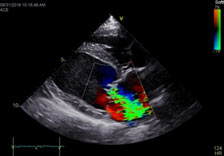 Echocardiogram_Newburgh_NY_2